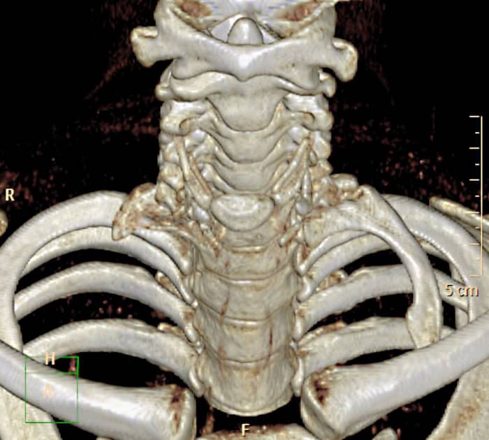 A 3D illustration of two cervical ribs above the normal ribs. One of the cervical ribs is more developed than the other,