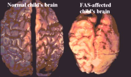 Influence of alcohol during nervous system system development (consumption of alcohol by pregnant mother).