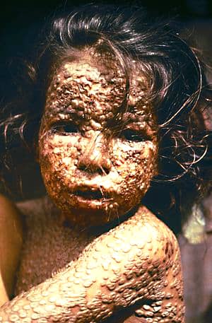 A Bangladeshi child who was affected by smallpox in 1973. Thanks to the work of people like Doctor Donald Henderson and his team, a sight like this will hopefully never be seen again, anywhere in the world
