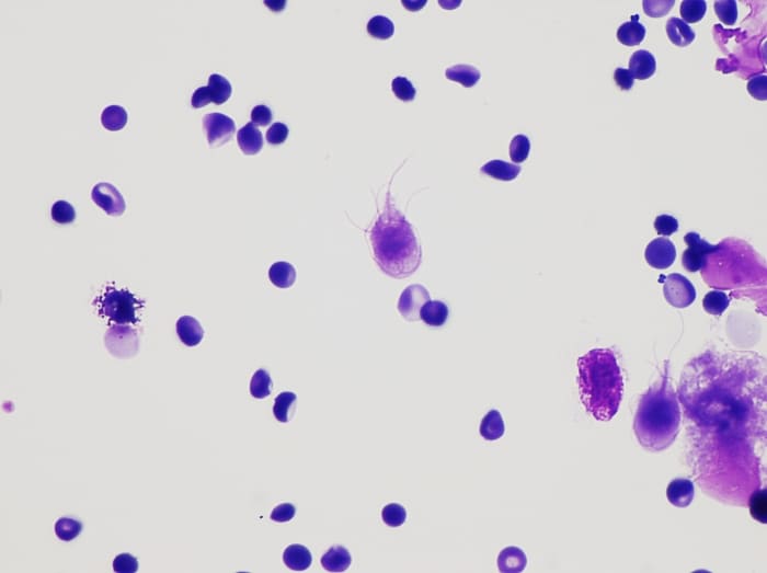 A stained preparation of Giardia lamblia from a patient