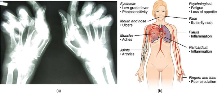 Visualizations of rheumatoid arthritis (left) and lupus (right), both autoimmune disorders.