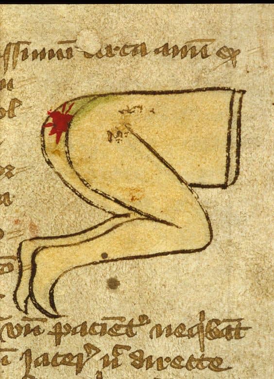 five-ancient-medical-treatments-we-consider-insane-today