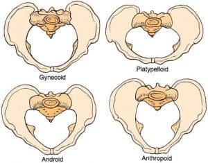 Four alternative female pelvic shapes. Android is considered the most masculine of the female pelvis and is least desirable for childbirth
