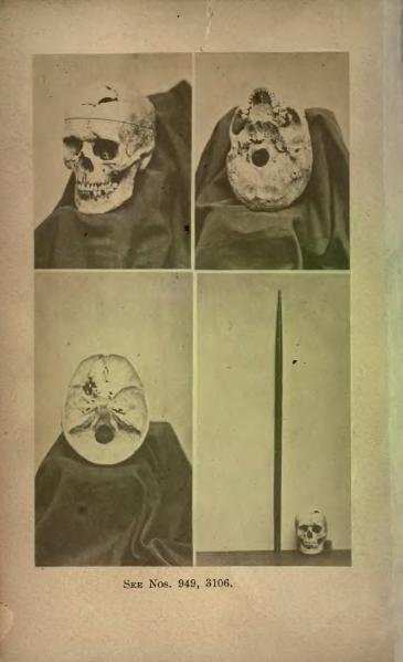 Actual Skull of Phineas Gage. Bottom left is the tamping iron shown beside the skull.