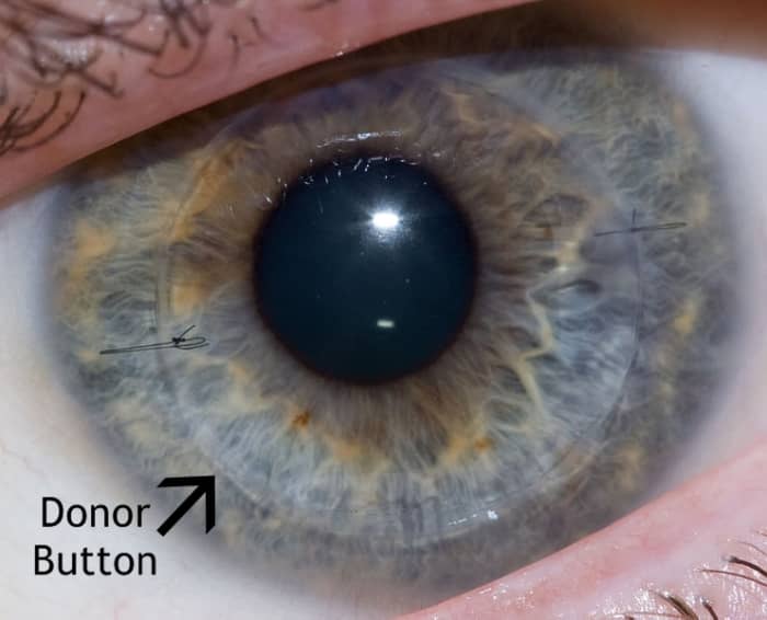 This is a one year old transplant, but you can still see the thin margin of the donor button (arrow).