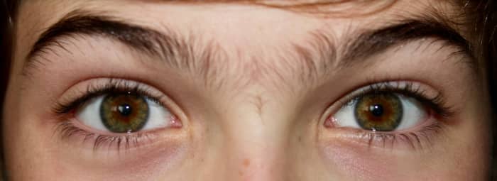 Central heterochromia causes melanin to be  concentrated around the pupil.