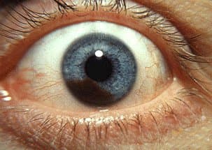 This is melanoma of the eye, not heterochromia.