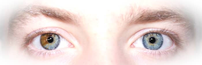 This photo shows partial heterochromia when one part of an iris is a different color.