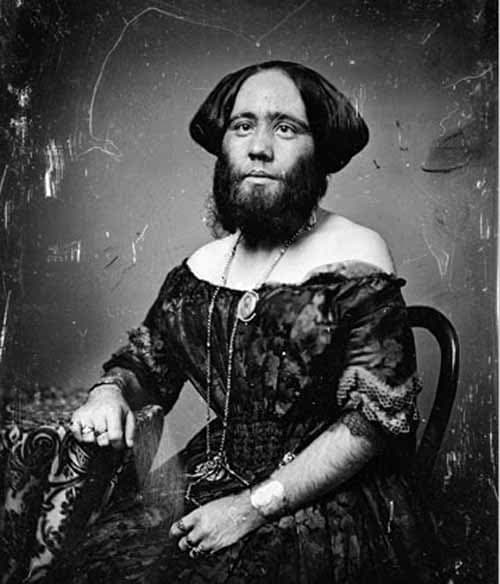 Clofullia participated in a sideshow at P.T. Barnum's American Museum in New York City alongside her young son, who inherited her hypertrichosis.