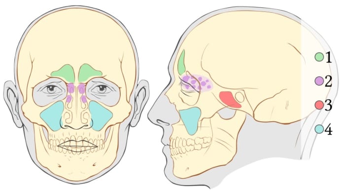 1 - frontal sinus, 2- ethmoid sinuses or ethmoidal air cells, 3 - sphenoid sinuses and 4 - maxillary sinuses