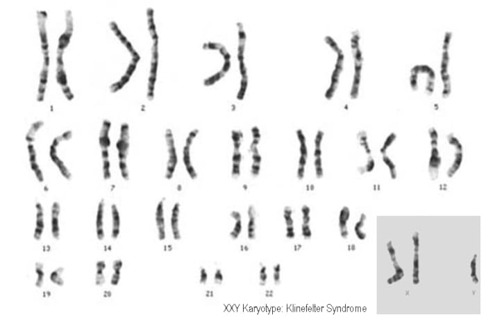 This is a karyotype of an individual with Klinefelter Syndrome: the individual has two X chromosomes and a Y chromosome (47, XXY).