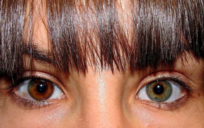 A woman with Heterochromia Iridium.