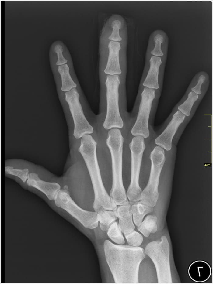 X-rays pass through our flesh and organs. The large calcium molecules that make up our skeleton block the path of x-rays. This results in the negative image seen here