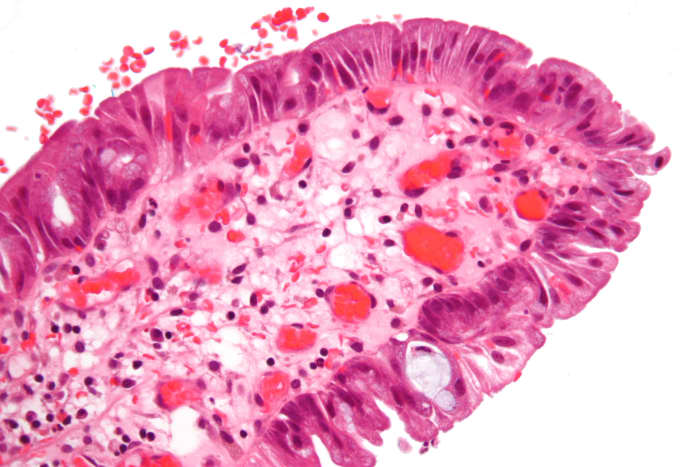 Mörkblå cellkärna; ljusrosa cellcytoplasma; röda erytrocyter (röda blodkroppar)