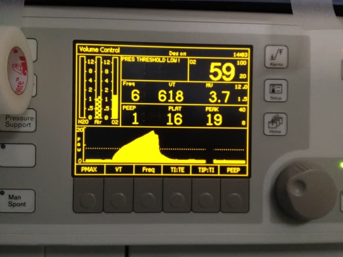 The ventilator used during anesthesia provides much useful information about breathing and the lungs.