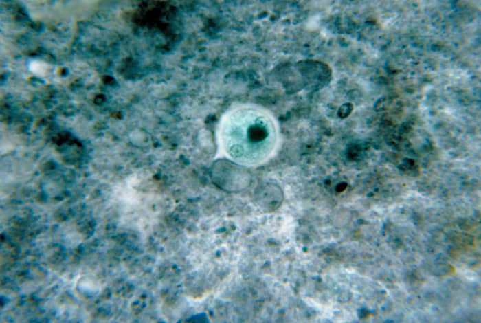 A stained Entamoeba histolytica cyst