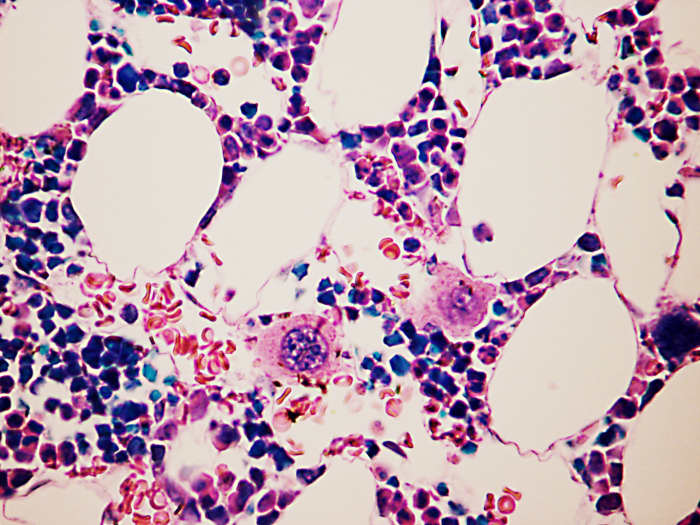 A magnified picture of bone marrow showing two megakaryocytes, which are the pink cells located slightly below the center of the image.