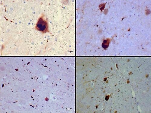 Protein Misfolding In Alzheimers And Parkinsons Diseases Owlcation 9404