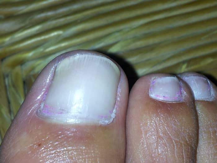 After six months, she was back to wearing nail polish on a new, clear nail. It has not returned.