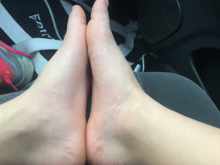 As soon as we hit the truck after the meet, my daughter removed her socks and shoes. I'm used to seeing her swollen here and there, but I knew this was a different kind of swollen. Unfortunately, it only got worse from here.