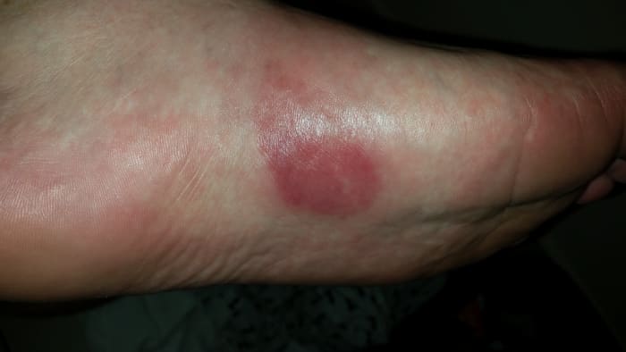 By day 2, the area was inflamed and very painful. I could barely walk on it and it was sore to touch