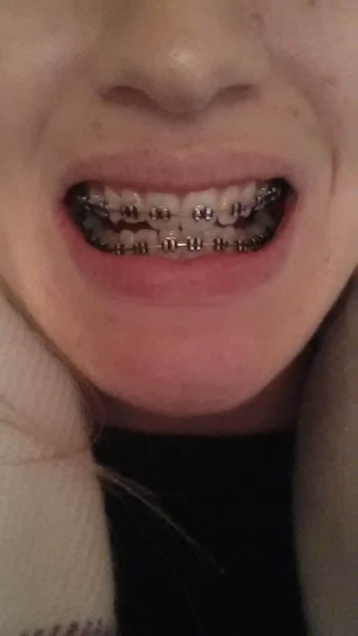 This was me a couple of months into the treatment. You can already see the straightening taking place.