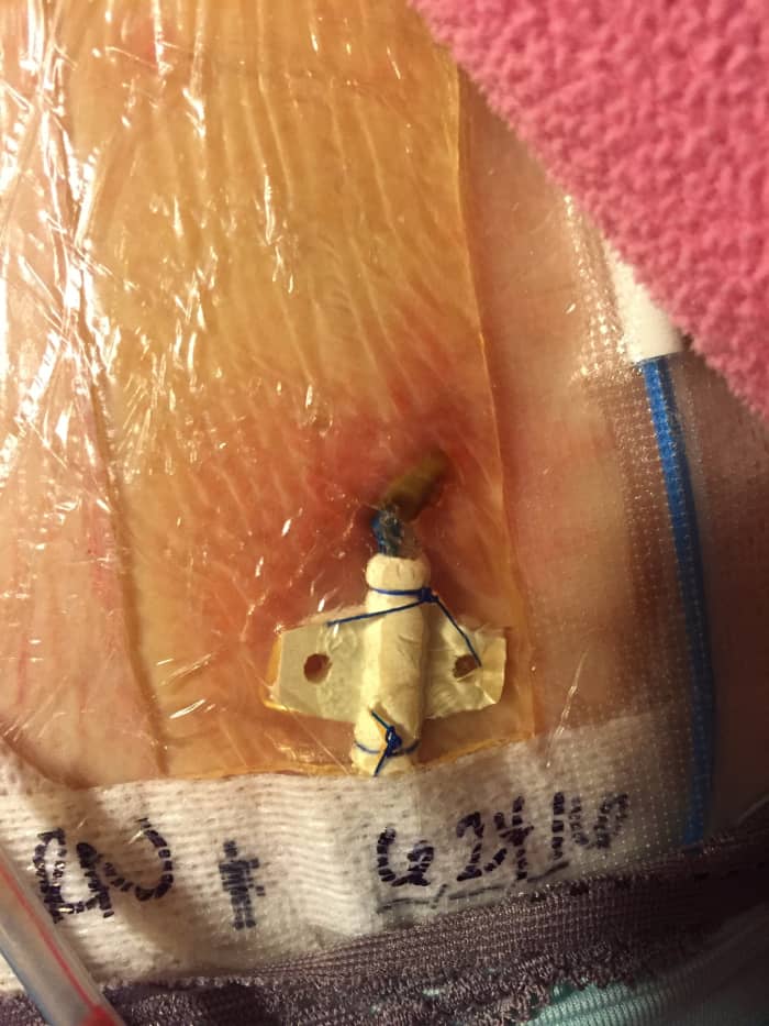 This is an infected central line. If this happens, they will pull out the infected line and give antibiotics. They will then replace another line about a week later (depending on your infectious disease doctor).