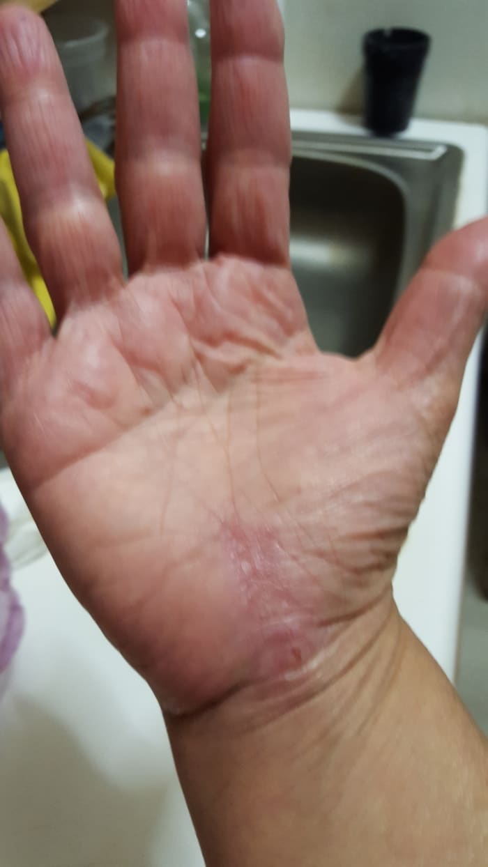 About a month after surgery on my right hand. I still have a visible scar, but that faded. I massaged my hand a lot to break up the scar tissue, and used arnica cream to relieve residual pain.