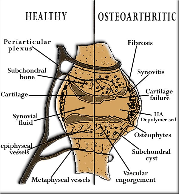 A healthy versus Osteoarthritic dog joint. Osteoarthritis causes the deterioration of an afflicted dogs joints.
