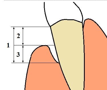 An example of gingival recession. Loss of supporting structure in advanced periodontal disease.