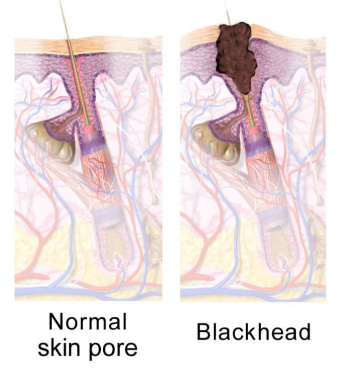 What do blackheads look like?