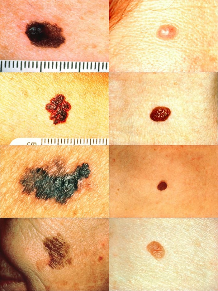 These are examples of melanoma (on left) vs. normal moles. Any abnormal mole or growth should be examined immediately