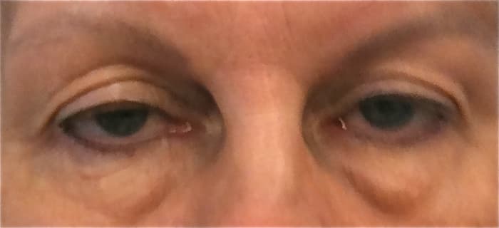 The excess skin in the upper eyelid inhibits this patient's range of vision. The patient also had elective surgery for fat pads and excess skin below the eyes.