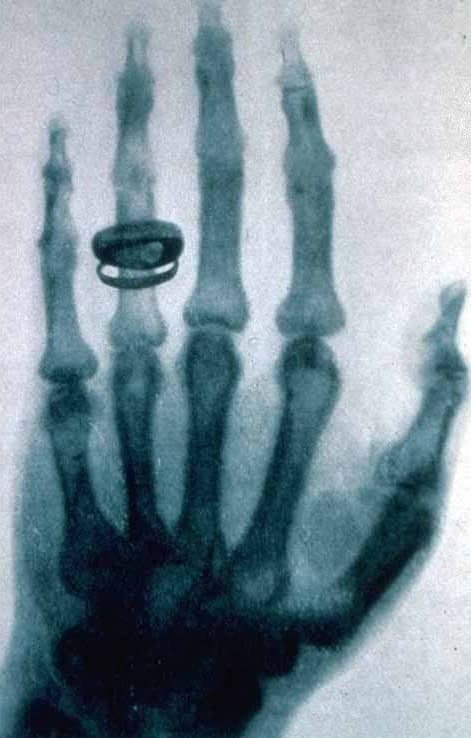 X-ray by the discoverer of x-rays, Wilhem Roentgen.