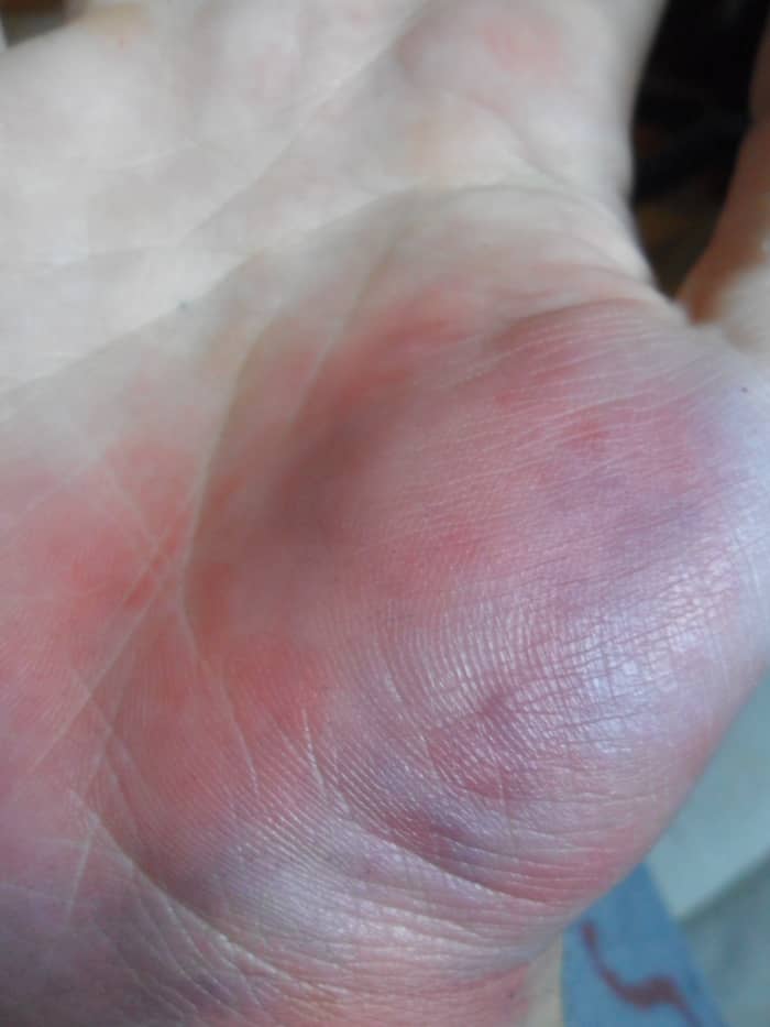 For a more realistic effect, taper your red color off slowly so it becomes fainter as it moves away from the bruise.