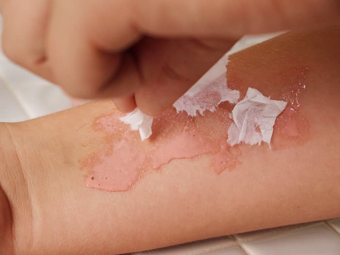 5. Arrange the bits of tissue on top of the glue. Arrange them around the outside of the "wound," leaving the middle area more open.