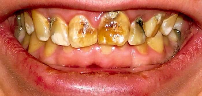 Dental fluorosis: 60% of the population has weakened enamel from excess exposure to fluoride during enamel formation (dental fluorosis.)