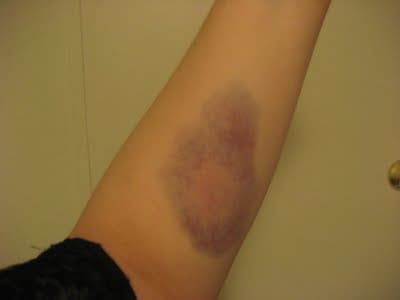 Not having the proper arm guard can lead to unsightly and painful bruises like this. Even a light pound bow can snap your arm quiet hard!