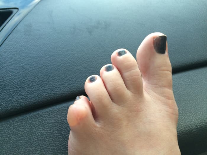 End result of 3 days with a crooked toe (from a prior surgery). I need to figure out a way to tape and pad this for future long hikes. The rocky terrain and constant twisting to navigate the mostly rock and boulder trails caused this.