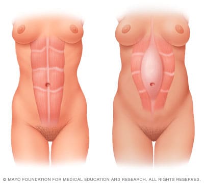 During pregnancy, the growing uterus sometimes causes the abdominal muscles to separate (diastasis recti).