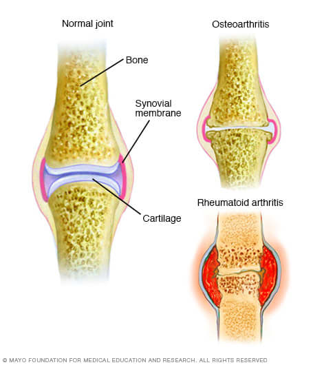 Osteoarthritis, the most common form of arthritis, involves the wearing away of the cartilage that caps the bones in your joints. With rheumatoid arthritis, the synovial membrane that protects and lubricates joints becomes inflamed, causing pain and
