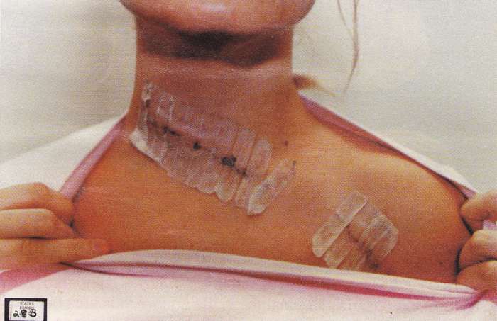 This one came within 2mm of her carotid artery.