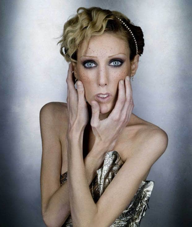 Isabelle Caro, a French model who became a symbol of the fight against anorexia when she was photographed naked for a controversial advertising campaign, has died at the age of 28