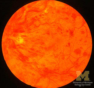This is a photograpgh of a retina following a retinal vein occlusion. The occlusion, caused by a blood clot, effectively stops blood leaving the retina. This kills the light sensitive cells, reducing vision rapidly, causing Blindness