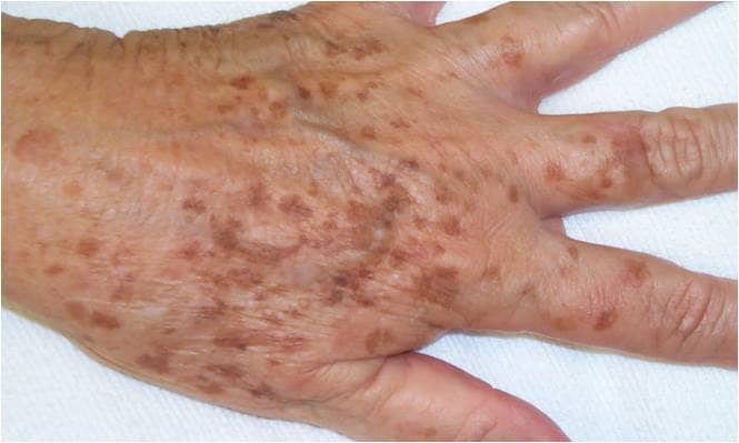 brown-liver-spots-on-the-face-and-skin-causes-prevention-and-removal