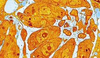 Toxoplasmosis. Coloured transmission electron micrograph (TEM) of Toxoplasma gondii parasites inside a human cell. Infection with these parasitic protozoa causes the disease toxoplasmosis.