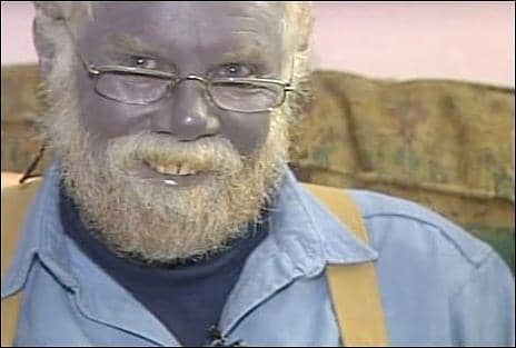 Paul Karason developed blue skin after using colloidal silver. Ironically, he was trying to treat a skin condition.