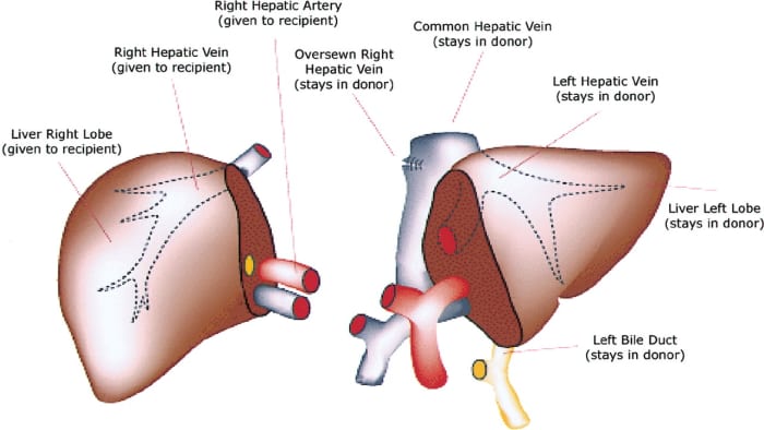 What is Liver Transplant - How and Why it is done? - HubPages