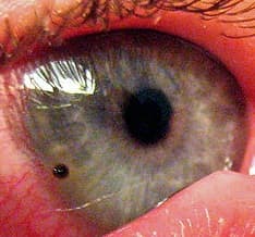This is a metallic corneal foreign body. This type of eye injury can cause what is known as a rust ring, which must be removed by an ophthalmologist.