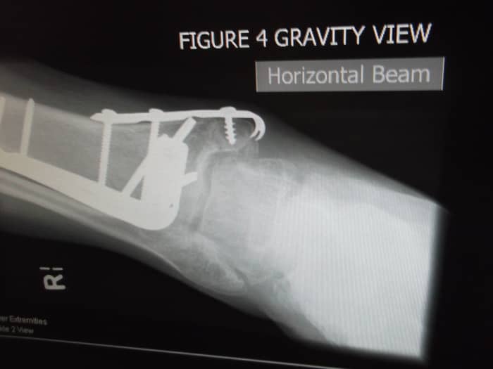 This is one of the later x-rays taken of my husband's ankle after surgery. It is a 'gravity view', clearly marked on the x-ray..